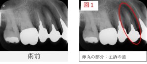 右上4番の初診時のレントゲン画像。右の画像では赤丸で根尖部に黒い影のある歯を示している（図1）。