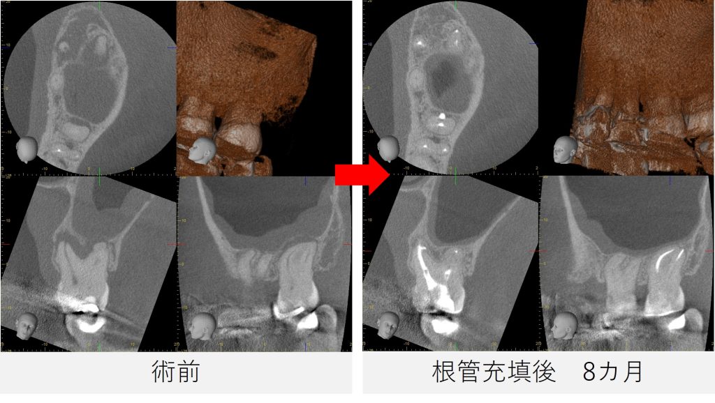 術前と根管充填後8か月のCT比較画像。左上7番の根尖部に見られた黒い影が縮小し、上顎洞の炎症が改善している様子が確認できる。
