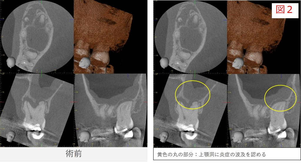左上７番の初診時のCT画像。根尖部に炎症が見られ、上顎洞内に炎症の波及を認める。（図2）
