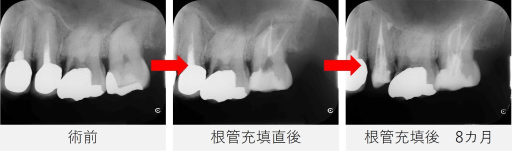 術前から根管充填後8か月までのレントゲン比較。左上7番の根尖部の黒い影が縮小し、骨の回復傾向が確認できる。