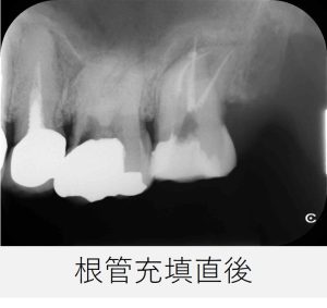 左上7番の根管充填直後のレントゲン画像