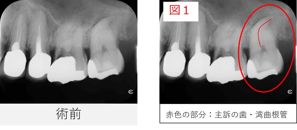 左上７番の初診時のレントゲン画像。主訴の歯と根管の強い湾曲が確認できる。(図1)