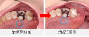治療開始前と治療3回目の口腔内写真、右上6番の内側の歯ぐきにあった瘻孔（ウミの出口）が無くなっている