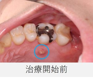 右上6番付近の歯ぐきにウミの出口である瘻孔が確認できる治療前の口腔内写真