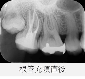 右上7番の根管充填直後のレントゲン画像