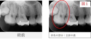 右上6番と7番の初診時レントゲン画像。原因と考えられた右上7番が赤丸で示されている(図1)