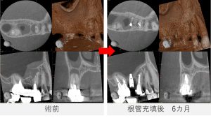 右上5番の術前と根管充填後6か月を比較したCT画像で、歯の根の先と側方にあった黒い影が改善している様子が確認できる画像