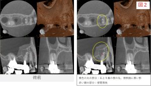 診時のCT画像で、右上5番の歯の根の先と側方に黒い影が確認できる画像