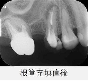 右上5番の根管充填直後のレントゲン画像