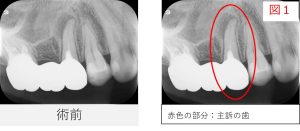 初診時のレントゲン画像で、右上5番の歯の根の先に黒い影が確認できる画像