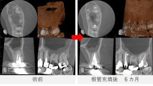 術前と根管充填後6か月のCT比較画像。左上5番の根尖部と側面に見られた黒い影が縮小し、炎症が改善している様子が確認できる。