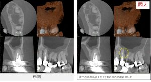 左上5番の初診時のCT画像。根の側面に透過像が確認できる。（図2）