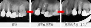 術前から根管充填後6か月までのレントゲン比較。左上5番の根尖部と側面の黒い影が縮小している。
