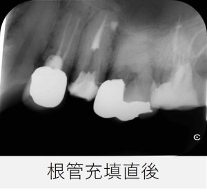 左上5番の根管充填直後のレントゲン画像
