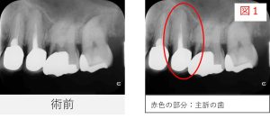 左上5番の初診時のレントゲン画像。主訴の歯を示している。(図1)
